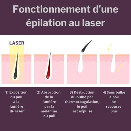 Schéma : fonctionnement d'une épilation au laser en 4 étapes